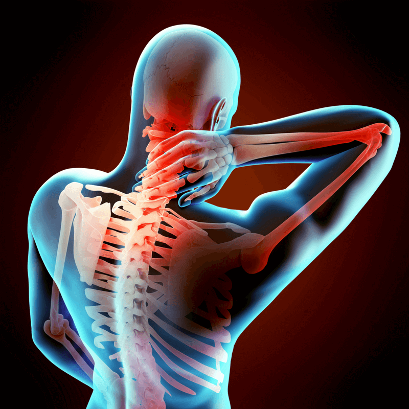 Scoliose: wat is het en wat kan je er aan doen?